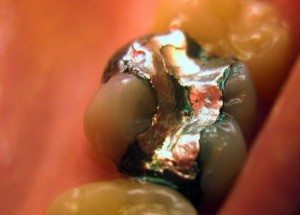amalgames-dentaires-mercure-danger